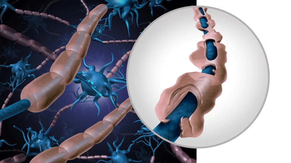 BCP’s Effects on Managing Inflammation in Multiple Sclerosis